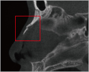 Nosal bone fracture
