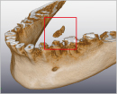 Lower jaw(VR) (Sialolithiasis disease) 