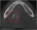 Lower jaw (Sialolithiasis disease)